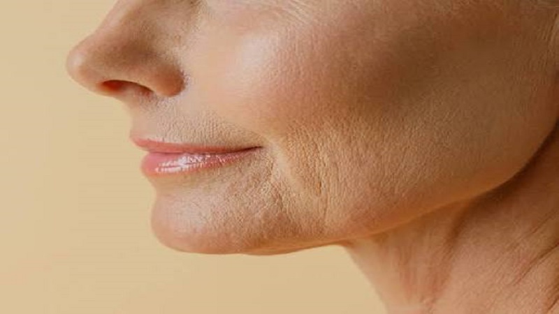 فیلر pre-jowl برای اصلاح افتادگی پایین صورت